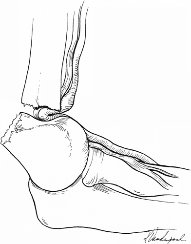 Proximal Humerus Fracture Humeral Malunion Retroversion Inclination ...